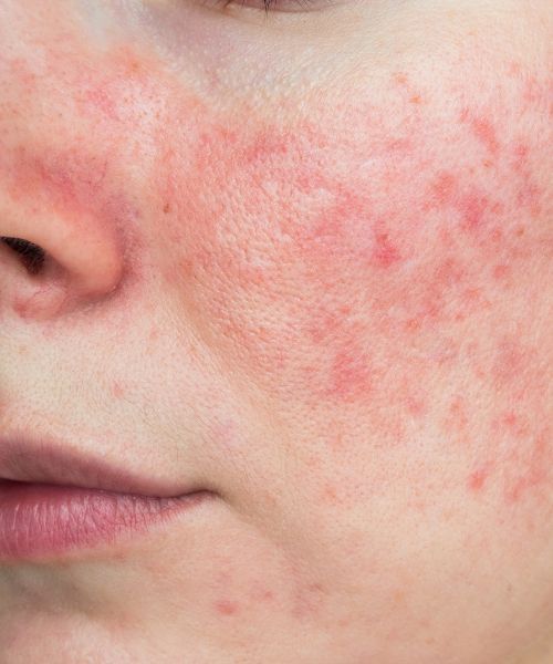 Best Korean Skincare for Sensitive Skin: A Gentle Guide