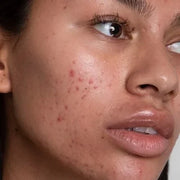 What Is Skin Purging? How Long Does It Last?